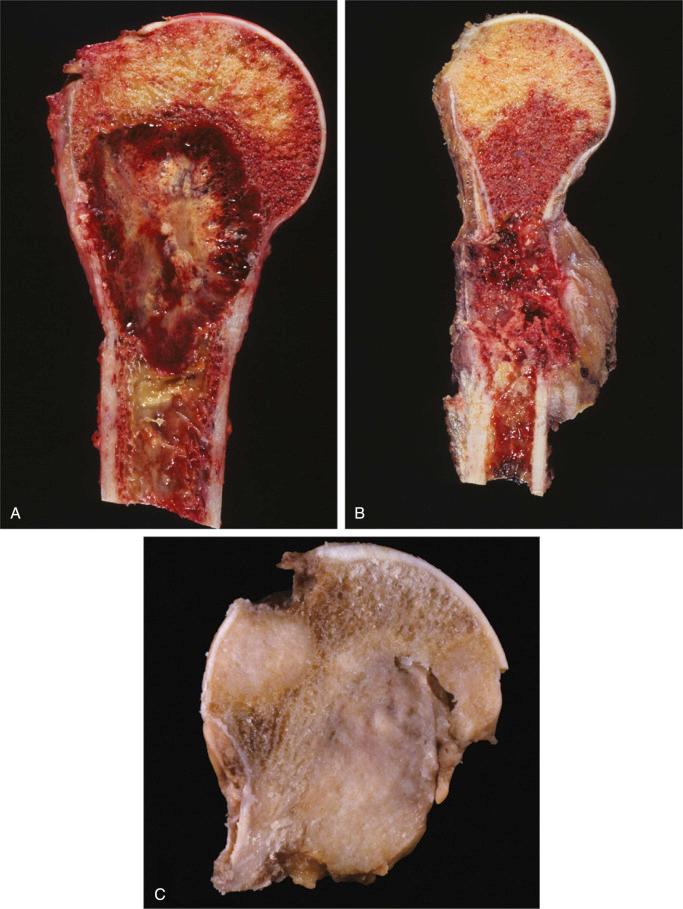 FIGURE 19-8, Metastatic carcinoma: gross features.