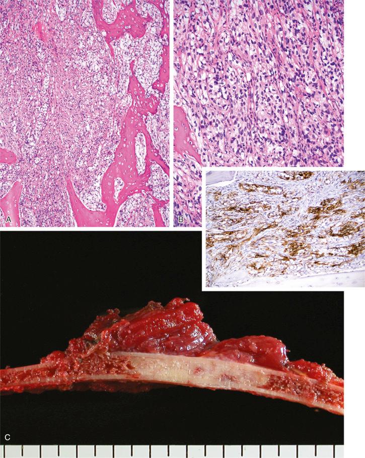 FIGURE 19-9, Metastatic carcinoma to rib, unknown primary.