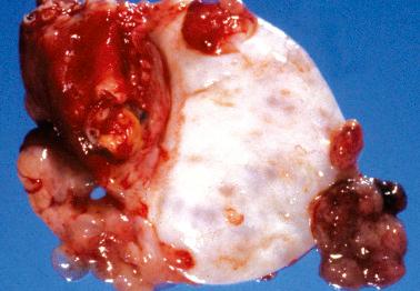 Fig. 18.1, Surface deposits of metastatic colon cancer, a feature typical of transcelomic spread of tumors from the gastrointestinal tract.