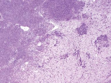 Fig. 18.11, Krukenberg tumor. Alternating hypercellular lobules and edematous regions are commonly seen.