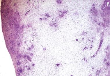 Fig. 18.12, Krukenberg tumor. Conspicuous edema, a feature of many such neoplasms, surrounding limited cellular foci.