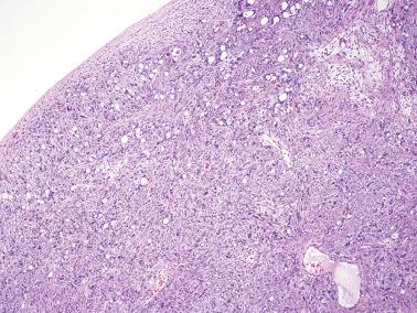 Fig. 18.13, Krukenberg tumor. Numerous signet-ring cells punctuate a hypercellular fibroblastic background.