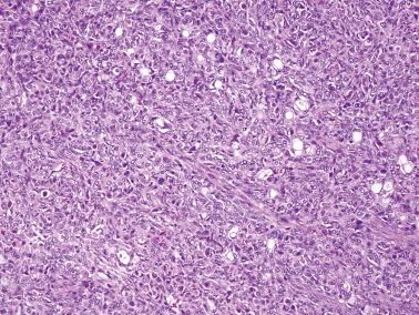 Fig. 18.14, Krukenberg tumor. Scattered signet-ring cells may be seen on a nonspecific appearing background of relatively uniform small cells.