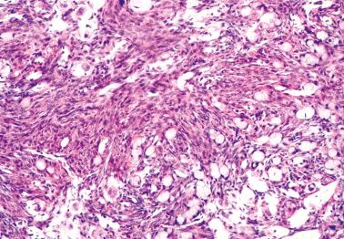 Fig. 18.15, Krukenberg tumor. Classic picture of signet-ring cells in a cellular stroma.