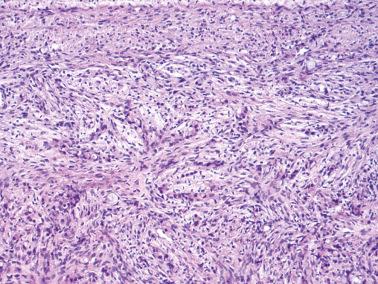 Fig. 18.16, Krukenberg tumor. Rare signet-ring cells are present on the background of a relatively bland-appearing fibromatous morphology. Such foci may be misinterpreted as fibroma, particularly in the frozen section setting.