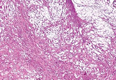 Fig. 18.17, Krukenberg tumor. Feathery degeneration, a term coined to designate a particular appearance of aggregates of mucin separated by scant acellular collagenous stroma.