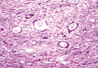 Fig. 18.19, Krukenberg tumor. Small glands with flattened lining cells impart a microcystic appearance.