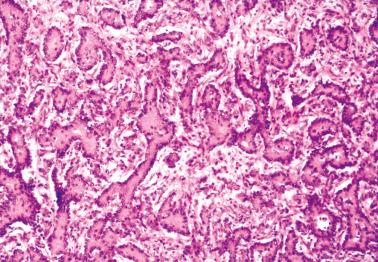 Fig. 18.20, Krukenberg tumor. There is a prominent solid tubular pattern resembling that of a Sertoli cell tumor.