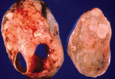 Fig. 18.2, Multiple nodules of metastatic appendiceal carcinoma are evident on the sectioned surface of this ovary. Multinodularity is seen in many metastases.