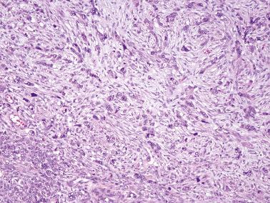 Fig. 18.21, Krukenberg tumor. This illustration shows a mostly nonspecific appearance but a few vacuoles containing targetoid eosinophilic material (best seen top center) are a clue to the diagnosis.