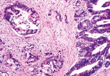 Fig. 18.22, Metastatic intestinal-type gastric adenocarcinoma to ovary. The large to small gland pattern is in marked contrast to the appearance of a Krukenberg tumor.