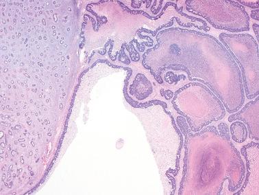 Fig. 18.25, Metastatic colorectal carcinoma. Typical heterogenous morphology with small glands in a desmoplastic stroma (left) abruptly interfacing with a glandular pattern with a garland-like cribriform pattern and conspicuous dirty necrosis.