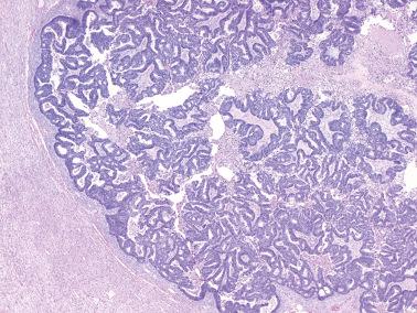 Fig. 18.26, Metastatic colorectal carcinoma. The tubular glandular pattern is reminiscent of an endometrioid carcinoma. Note the dirty necrosis.