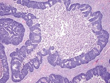 Fig. 18.27, Metastatic colorectal carcinoma. Classic garland-like arrangement of cribriform glands at the periphery of a large gland whose lumen is filled with necrotic debris.