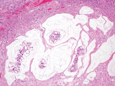 Fig. 18.28, Metastatic colorectal carcinoma. Typical colloid morphology, which is rarely a feature of primary mucinous carcinoma of the ovary.