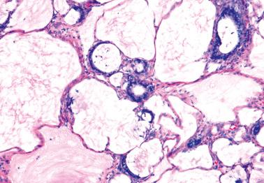 Fig. 18.29, Metastatic colonic adenocarcinoma to ovary with a colloid pattern.