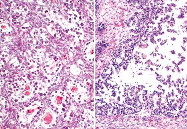 Fig. 18.30, Metastatic colonic adenocarcinomas to ovary with unusual phenotypes. Left: Metastatic clear cell colonic adenocarcinoma mimics a primary ovarian clear cell adenocarcinoma. Right: A striking micropapillary pattern potentially mimics a serous adenocarcinoma.