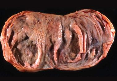 Fig. 18.3, Cystic metastasis of metastatic pancreatic adenocarcinoma.