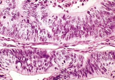 Fig. 18.31, Metastatic colonic adenocarcinoma to ovary, typical high-power appearance. Note high-grade nuclear features with mitotic figures.