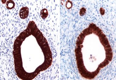 Fig. 18.32, Metastatic colonic adenocarcinoma to ovary with immunoreactivity for CK20 (left) and CDX2 (right). Endometrioid adenocarcinoma, which is in the differential diagnosis, is typically negative for both markers.