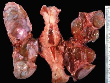 Fig. 18.33, Metastatic low-grade appendiceal mucinous neoplasm to ovaries. Bilateral mucinous cystic neoplasms are seen with jelly-like material being evident on the right.