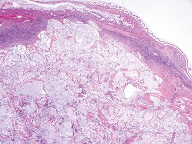 Fig. 18.35, Metastatic low-grade appendiceal mucinous neoplasm. The ovarian parenchyma is largely replaced by pools of mucin with scant epithelium. Typical columnar mucinous epithelium is, however, seen on the ovarian surface.