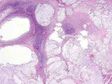 Fig. 18.36, Metastatic low-grade appendiceal mucinous neoplasm. Pools of mucin dissect through an otherwise unaltered ovarian stroma, so-called pseudomyxoma ovarii.