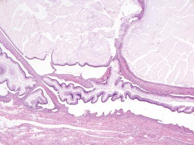 Fig. 18.37, Metastatic low-grade appendiceal mucinous neoplasm. Typical tall columnar cells are seen and have extensively retracted from the adjacent stroma. This feature is typical of metastatic low-grade appendiceal mucinous tumors but may also be seen with teratoma-associated primary tumors.