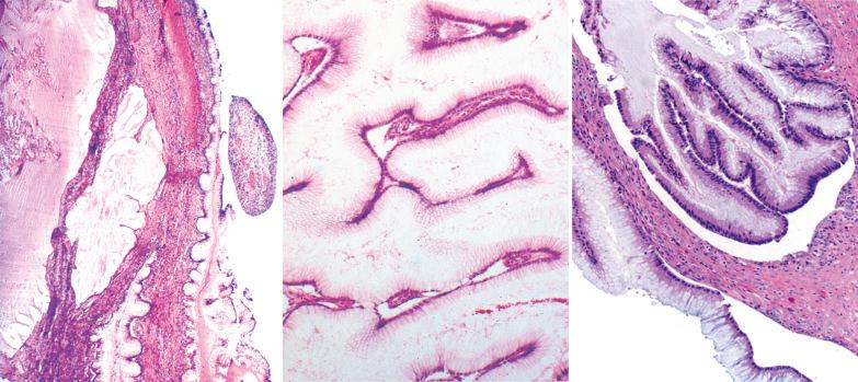 Fig. 18.38, Metastatic low-grade appendiceal mucinous neoplasm to ovary. Left: There is both parenchymal involvement and surface involvement by differentiated mucinous epithelium. Center: Note typical highly differentiated tall columnar mucinous epithelial cells. Right: Note tendency for the neoplastic epithelium to lift off from the stroma, creating a cleft-like space, a characteristic feature that is suggestive of the diagnosis.