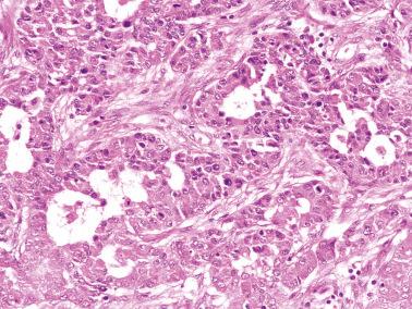 Fig. 18.39, Metastatic appendiceal adenocarcinoma to ovary. Many of the glands in this neoplasm mimicked an endometrioid adenocarcinoma.