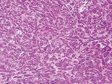 Fig. 18.40, Metastatic appendiceal adenocarcinoma to ovary. This neoplasm had a conspicuous tubular pattern, potentially mimicking a Sertoli–Leydig cell tumor. Although not evident in this image, signet-ring cells were present elsewhere (so-called tubular Krukenberg tumor).