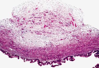 Fig. 18.4, Typical surface implant of metastatic pancreatic adenocarcinoma. The cancer within a desmoplastic stroma has resulted in a nodular projection above the level of the adjacent superficial cortex. As the tumor has spread into the underlying parenchyma, it has matured with the formation of the cyst seen at the bottom.