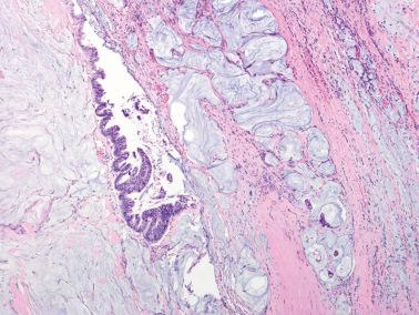 Fig. 18.41, Metastatic moderately differentiated adenocarcinoma of the appendix to the ovary. Pools of mucin are conspicuous. Note the atypicality of the mucinous epithelium that is present.