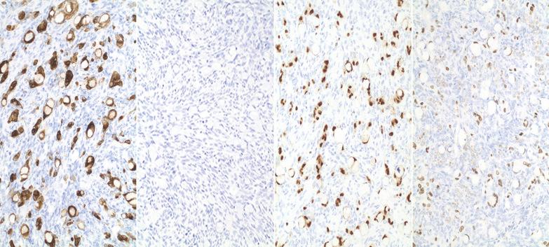 Fig. 18.43, Metastatic signet-ring cell carcinoma from the appendix. A typical immunohistochemical expression pattern is seen (from left to right - CK20 positive, CK7 negative, CDX2 positive, SATB2 positive).