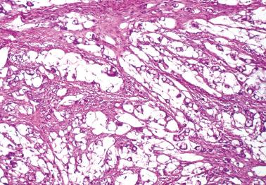 Fig. 18.44, Metastatic mucinous adenocarcinoma of appendix to ovary.