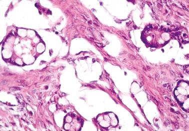 Fig. 18.45, Metastatic mucinous adenocarcinoma of appendix to ovary. Small aggregates of mucinous cells have a pattern reminiscent of the formations seen in mucinous carcinoid tumors.