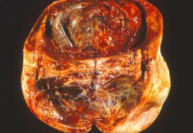 Fig. 18.46, Metastatic ileal well-differentiated neuroendocrine (carcinoid) tumor to ovary with a striking cystic appearance.