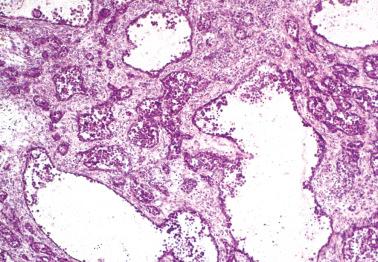 Fig. 18.47, Metastatic well-differentiated neuroendocrine (carcinoid) tumor to ovary. Prominent follicle-like spaces impart an unusual picture.