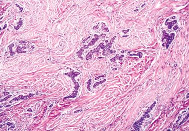 Fig. 18.48, Metastatic well-differentiated neuroendocrine (carcinoid) tumor to ovary. Small nests of carcinoid lie in a prominent fibromatous stroma.