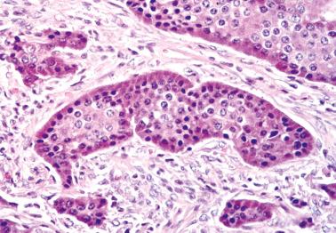 Fig. 18.49, Metastatic well-differentiated neuroendocrine (carcinoid) tumor to ovary with insular pattern and clearly evident cytoplasmic granules.