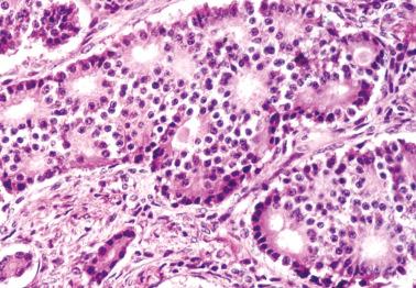 Fig. 18.50, Metastatic well-differentiated neuroendocrine (carcinoid) tumor to ovary with a typical acinar pattern.