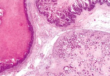 Fig. 18.5, Heterogeneous nodular growth. Three separate distinct patterns of growth are evident in this case of metastatic colon cancer. A dilated gland at the left, conventional adenocarcinoma at the top, and small gland adenocarcinoma in a prominent desmoplastic stroma at the bottom right.