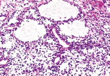 Fig. 18.6, Follicle-like spaces in case of metastatic malignant melanoma.