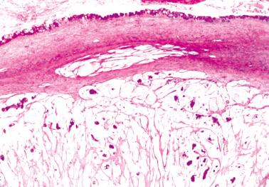 Fig. 18.7, Colloid adenocarcinoma metastatic in the ovary. This pattern of mucinous carcinoma is uncommonly primary in the ovary and accordingly such a picture should suggest strongly a metastasis.