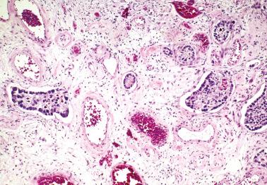 Fig. 18.8, Prominent lymphatic involvement by metastatic carcinoma in the ovary, a common feature of metastatic cancers.