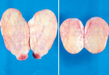 Fig. 18.9, Krukenberg tumor. Bilateral tumors have uniformly solid sectioned surfaces.