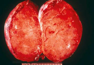 Fig. 18.10, Krukenberg tumor. This neoplasm was soft and edematous with a rim of beefy red tissue.