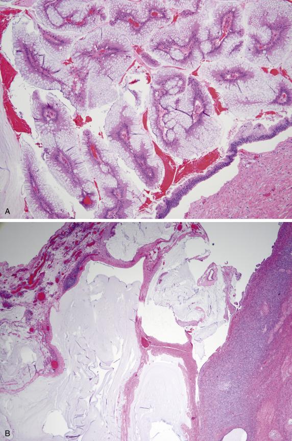 FIG. 17.11, Low-grade appendiceal mucinous neoplasm with secondary ovarian involvement. The tumor cells show tall “hypermucinous” cytoplasm, and they form glands with undulating outlines and subepithelial clefting (A). Acellular mucin dissects through paraovarian soft tissue (B).