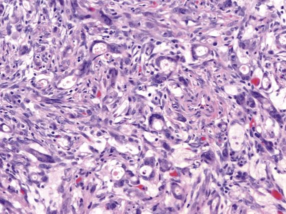 FIG. 17.12, Metastatic appendiceal adenocarcinoma. The tumor cells show prominent cytologic atypia.