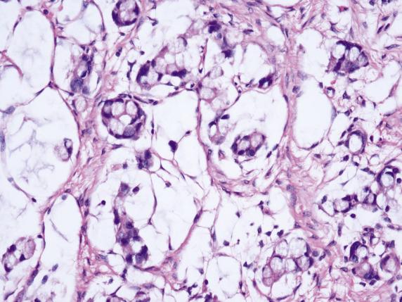 FIG. 17.13, Metastatic appendiceal adenocarcinoma. Closely apposed nests of signet-ring cells are present in pools of mucin.